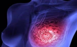 tecnología Eva para detectar cáncer de mama