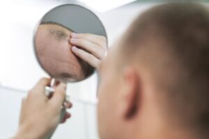 25 millones de mexicanos entre 24 y 54 años son propensos a la alopecia; lanzan campaña de diagnóstico gratuito
